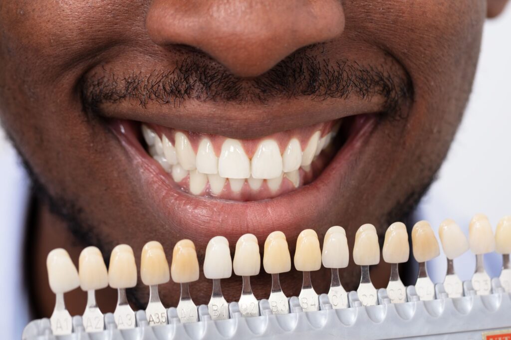 porcelain veneer treatment